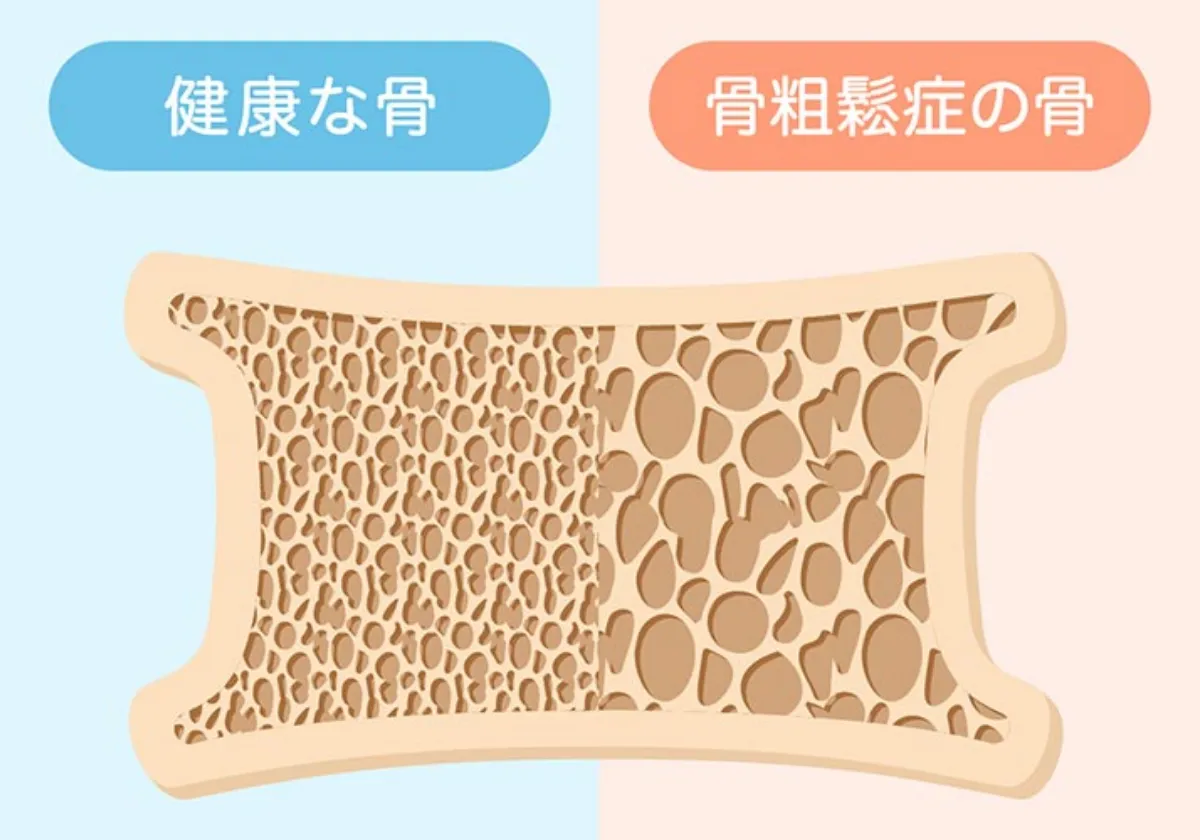 骨粗鬆症を含め患者様の骨の健康をお守りしますイメージ画像