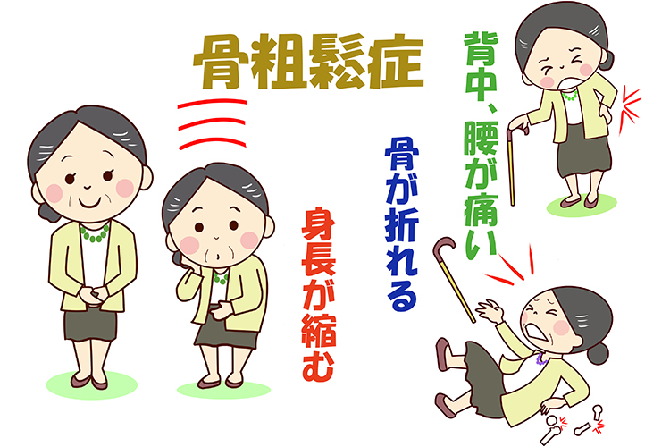 骨粗鬆症とは