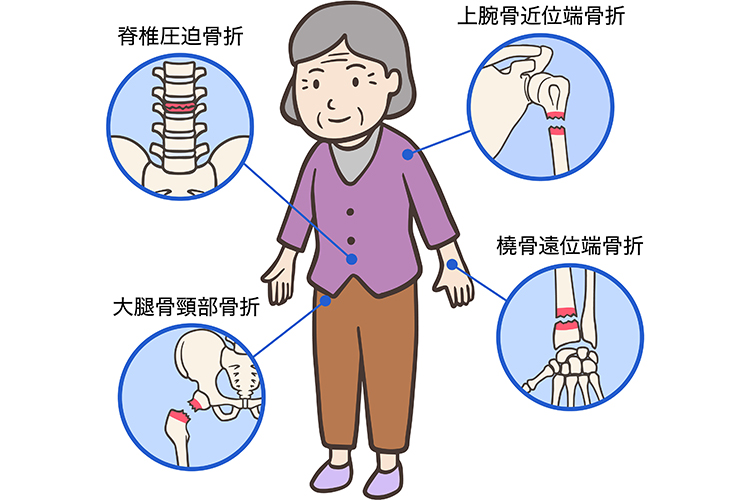 骨粗鬆症で骨折？！